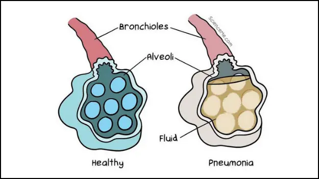 Pneumonia can seriously damage alveoli in the lungs